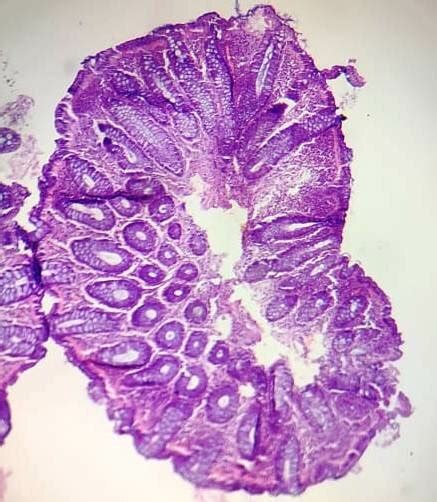 Showing an adenomatous polyp with tubular architecture (H&E Stain 100X). | Download Scientific ...