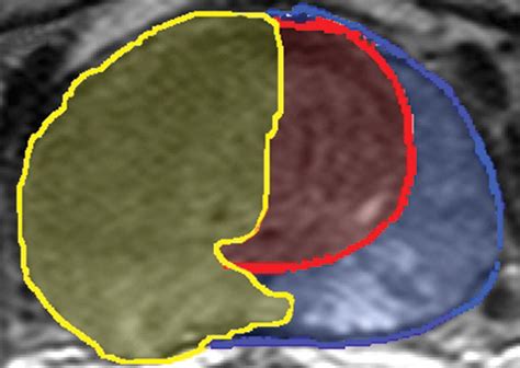 MRI In The Detection Of Prostate Cancer Combined Apparent Diffusion