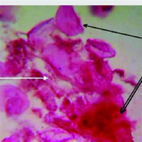 Fnac Smear From A Case Of Dermoid Cyst Showing Benign Squamous