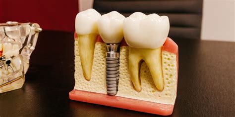 Cost Of Dental Implants In 2021 Everything You Need To Know Narre Warren Dental Care