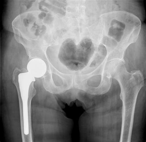 DePuy Hip Replacement Lawsuits - Feeney Law Firm