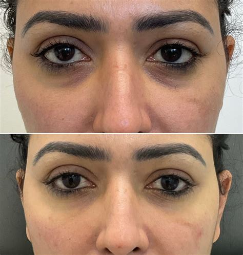 Dermal Filler Before And After Gallery Nurse Jacklyn