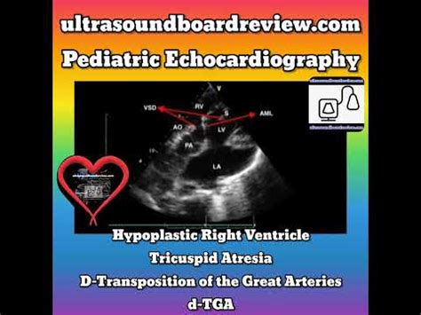 Tricuspid Atresia YouTube