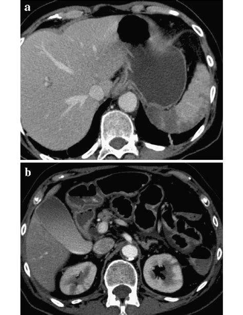 Ct Findings Of Peritoneal Cavity 1 Axial Contrast Enhanced Ct Image