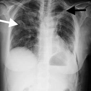 b. CT of the chest revealed a 4x3-cm cavitary lesion with a thick wall... | Download Scientific ...