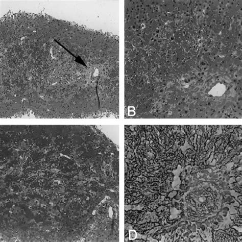 Histologic Features Of The Liver Biopsy Specimen A Low Power View