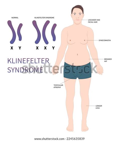 Klinefelter Syndrome Causes Symptoms Treatment Diagnosis Atelier Yuwa