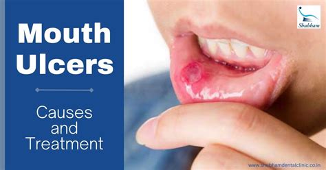 Mouth Ulcers Causes And Treatment Shubham Dental Clinic