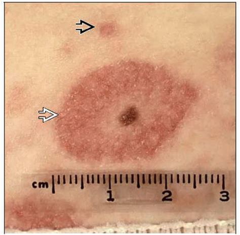 Herald Patch Pityriasis Rosea Causes Mevaswiss