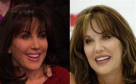 Robin McGraw plastic surgery before and after