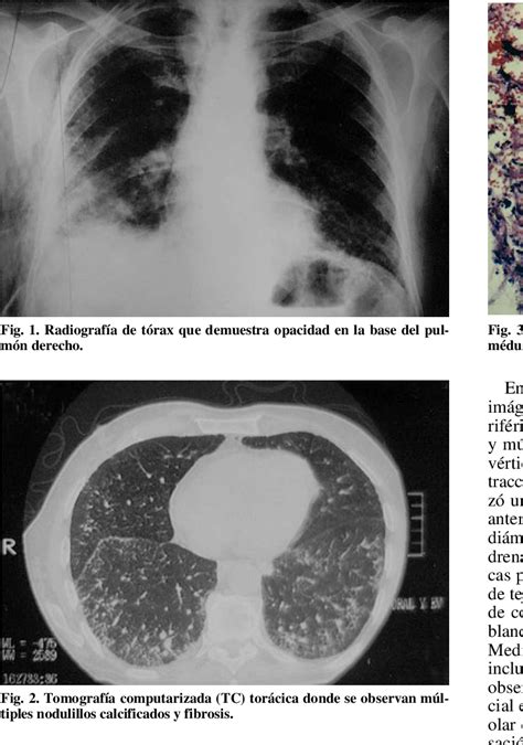 Figure 3 from Osificación pulmonar difusa asociada a fibrosis pulmonar