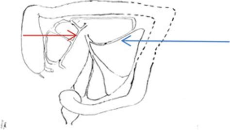 Schematic Diagram Of The Vascular Supply Of The Splenic Flexure