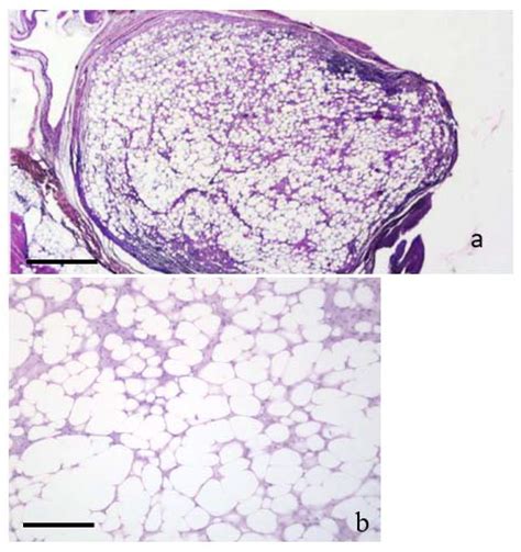 Lipoma Histology