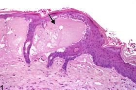 Skin - Vesicle - Nonneoplastic Lesion Atlas