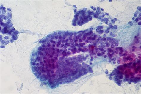 Papillary Carcinoma Of Thyroid Fna Ed Uthman Flickr