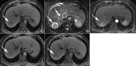 肝脏影像报告和数据系统肝癌mri辅助征象解析信号