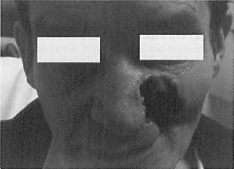 Figure 1 From Use Of A Perimeter Technique With Mohs Micrographic