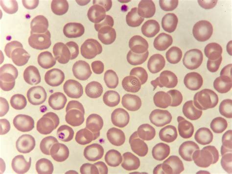 Abnormal Red Blood Cells In Blood Smear Stock Photo Image Of