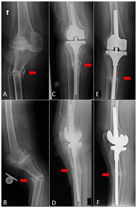 Shaft Fractures In Patients Requiring Primary Or Revision Total Knee