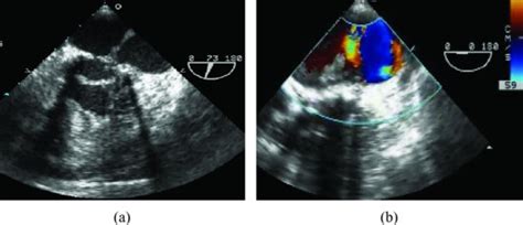 Mitral Valve Repair With The Use Of An Annuloplasty Ring The