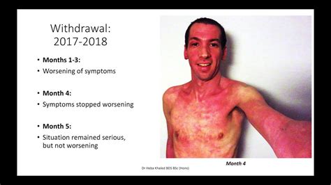 Tsw Topical Steroid Withdrawal Case Example Santiago Aufranc Youtube