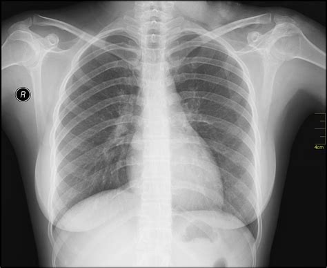 File Medical X Ray Imaging Aso02 Nevit  Wikimedia Commons