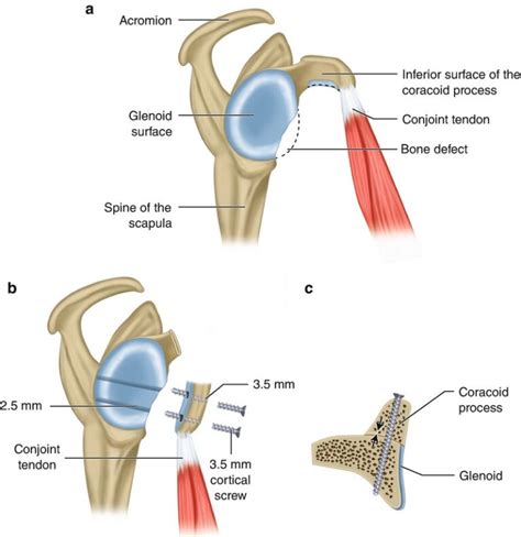 Shoulder Instability Sun Orthopaedic