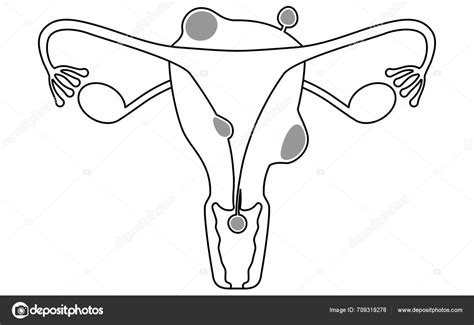 Diagrammatic Illustration Uterine Fibroids Anatomy Uterus Ovaries