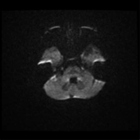 Neurofibromatosis Type With Multiple Meningiomas Image