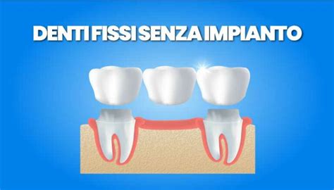 Denti Fissi Senza Impianto Risparmia Tempo E Denaro