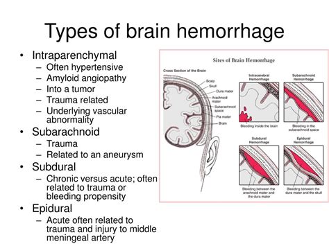 Different Types Of Brain Hemorrhage