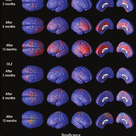 Progressive Gray Matter Loss After Year Statistical Maps Show The