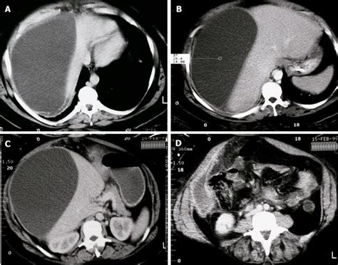 Successful Percutaneous Drainage Of A Giant Hydatid Cyst In The Liver