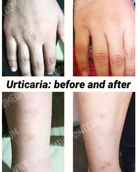 Cure Of Urticaria Hives With Homeopathy Homeopathypoint