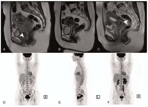 Primary Signet Ring Cell Carcinoma Of The Uterine Cervix A Case Report