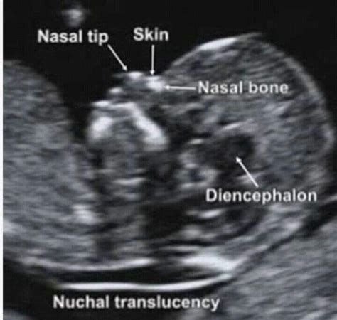 Nuchal Translucency Ultrasound Artofit