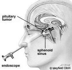 Pituitary Tumour Surgery at best price in Nagpur | ID: 10529265448