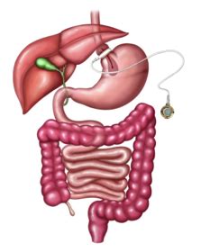 Adjustable Gastric Banding UF Health