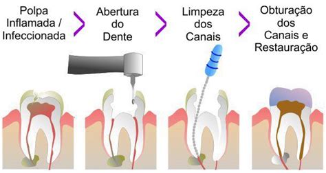 Canal Infeccionado O Que Fazer - O tratamento de canal é o procedimento indicado:
