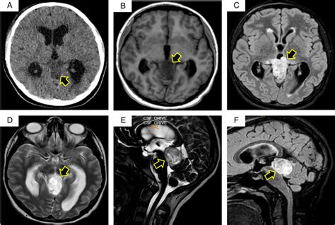 Large Pineal Parenchymal Tumor Of Intermediate Differentiation Causing