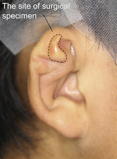 Cauliflower Ear Surgery