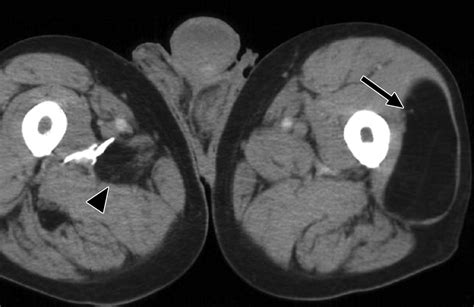 Soft Tissue Masses And Masslike Conditions What Does Ct Add To Diagnosis And Management Ajr