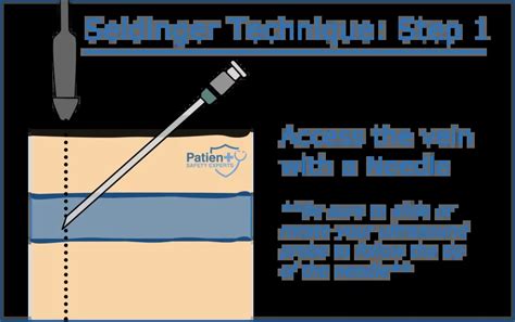 The Seldinger Technique: A Comprehensive Guide - Patient Safety Experts