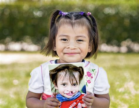 Smile Train México celebra el Día del Labio y Paladar Hendido SaludyVida