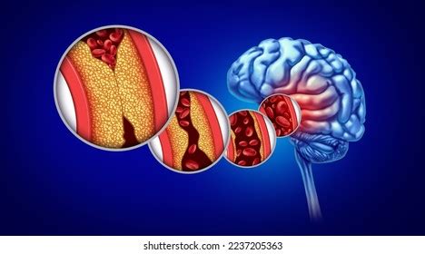 Stroke Atherosclerosis Brain Disorder Caused By Stock Illustration ...