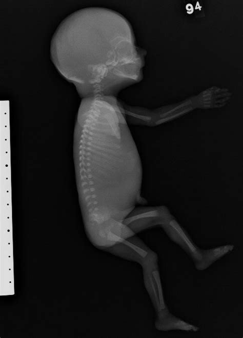 Meromelia Human Pathology