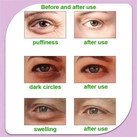 Gel Ice Pack Reusable Cooling Eye Pads And Under Eye Patches Eye Hot Cold Pack For Eye Relax