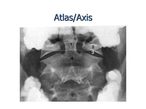 xray view of atlas and axis Diagram | Quizlet