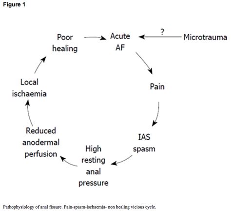 Anal Fissures Handout Time Of Care