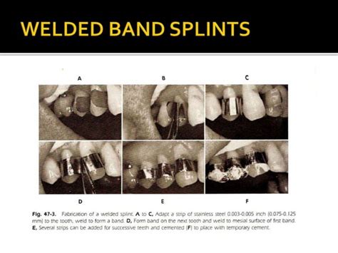 Periodontal splinting